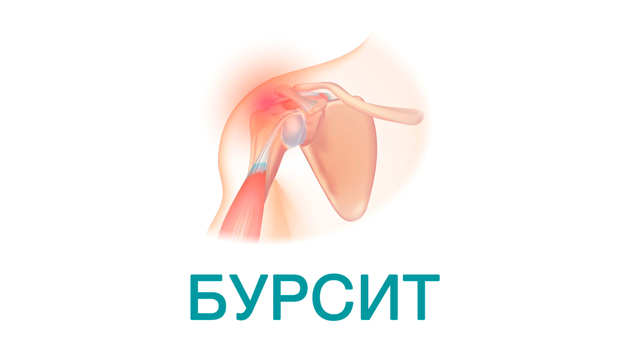 бурсит