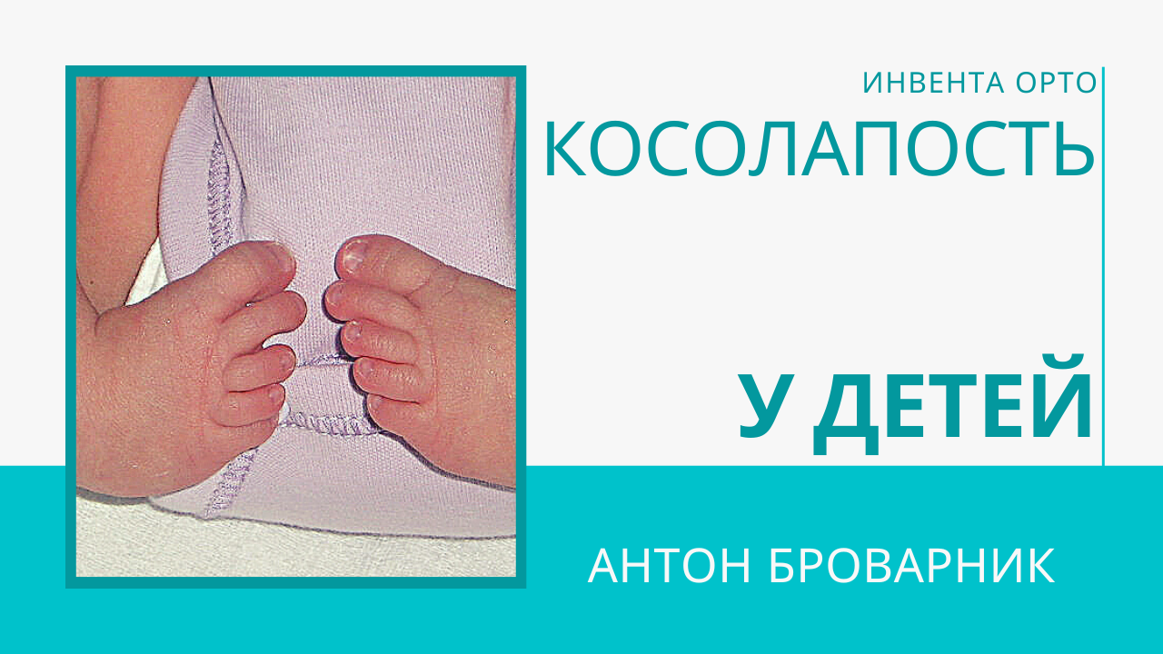 Как вылечить косолапость у детей
