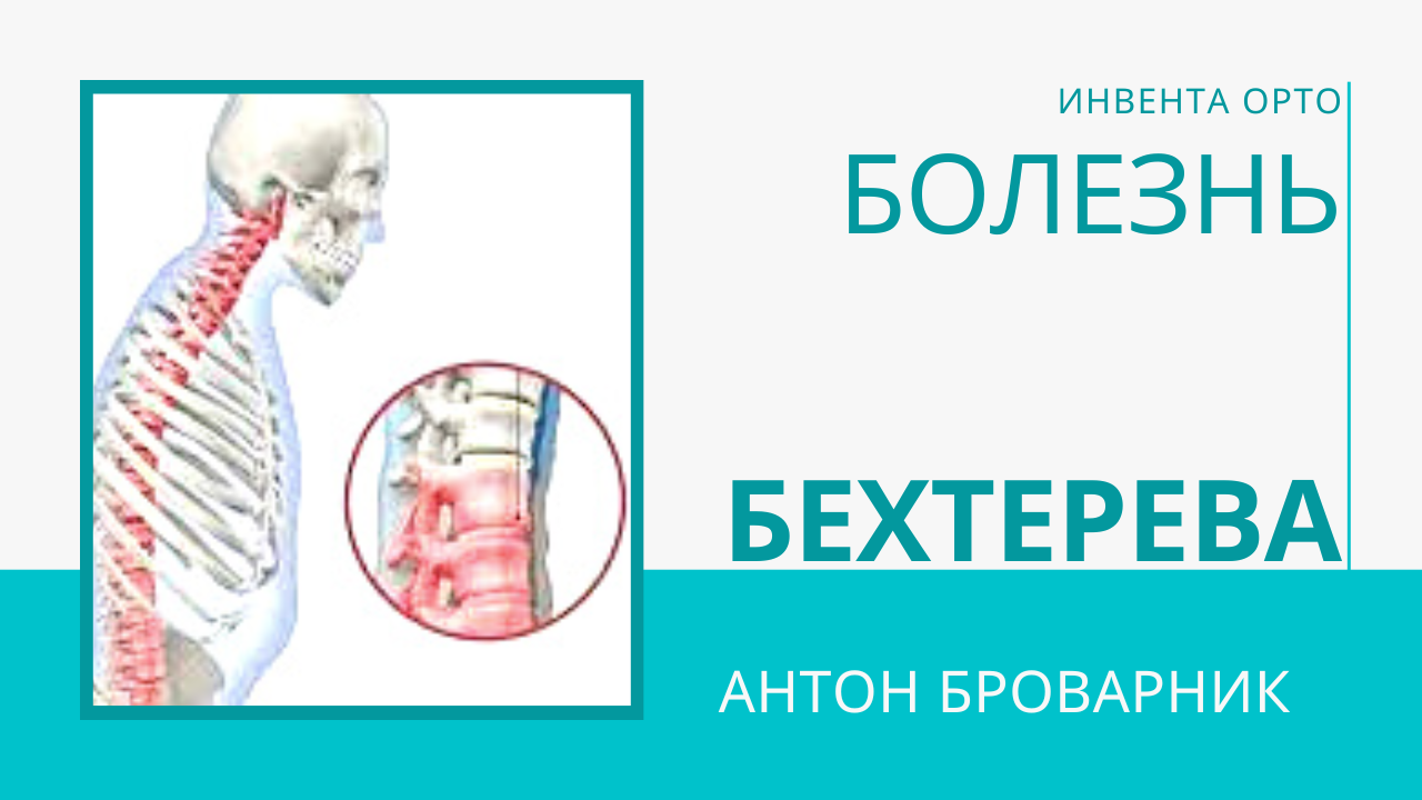 спондилит лечение